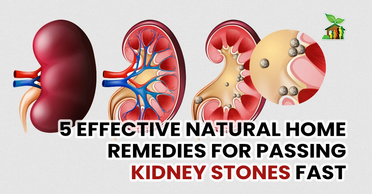5 Effective Natural Home Remedies for Passing Kidney Stones Fast