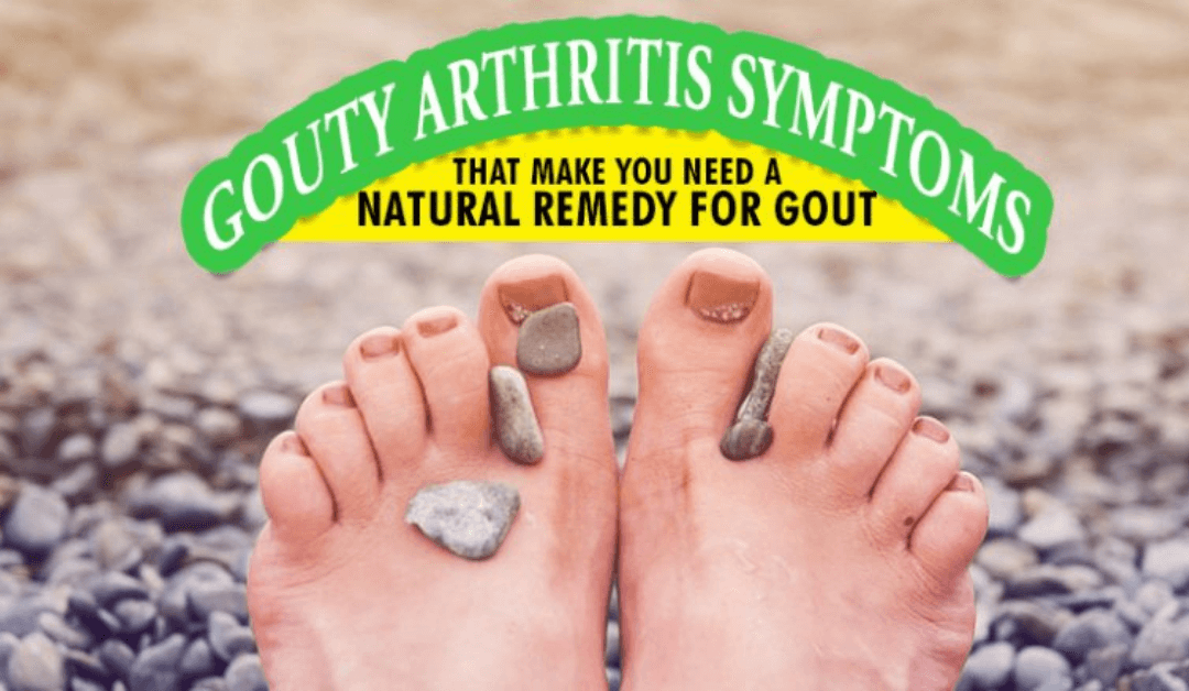 Gouty Arthritis Symptoms That Make You Need A Natural Remedy For Gout